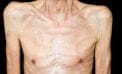 cachexia, cancer Muscle wasting syndrome cause of many cancer-related deaths